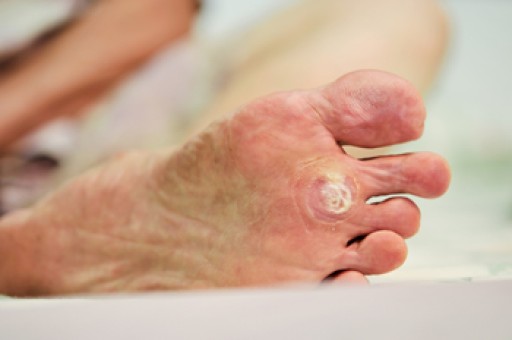 How to Care for Plantar Warts