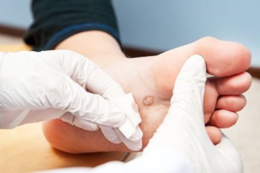 Where Is a Plantar Wart Found?