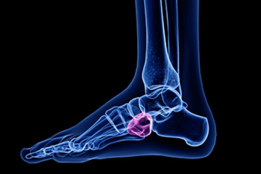 Cuboid Syndrome From Pronated Feet