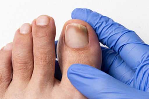 Psychological Effects of Toenail Fungus