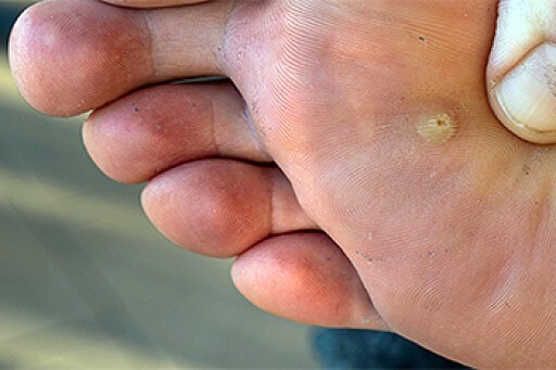 Plantar Warts May Be Rough or Smooth