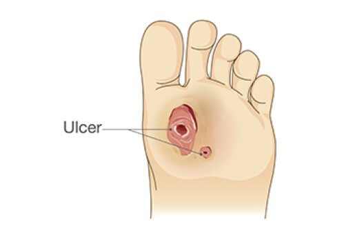 Diabetic Foot Conditions