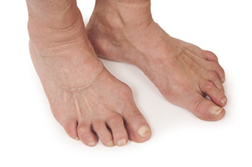 Rheumatoid Arthritis in the Feet