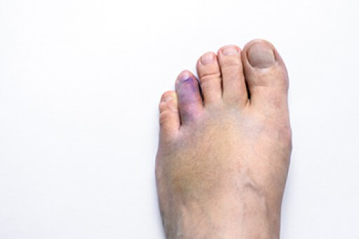 What to Know About a Broken Toe