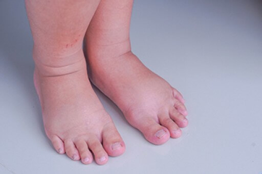 Swelling of the Feet