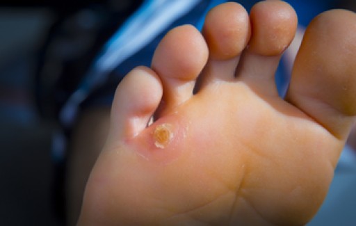 Causes of Foot Corns